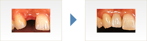 歯を1本失った場合