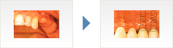 歯を1本失った場合