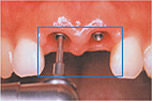 前歯の差し歯を抜歯するインプラントのイメージ