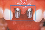 前歯の差し歯を抜歯するインプラント