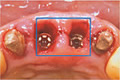 前歯を連続してインプラントにするのイメージ