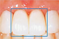 前歯を連続してインプラントにするのイメージ